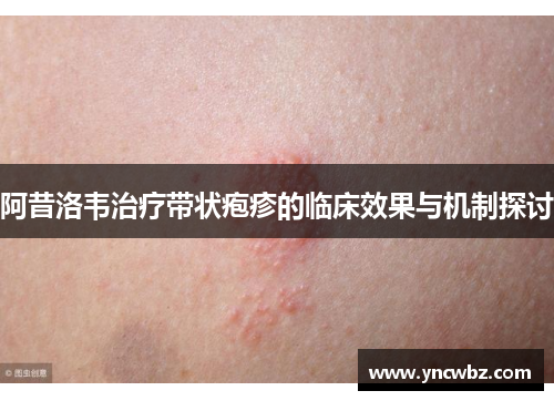 阿昔洛韦治疗带状疱疹的临床效果与机制探讨